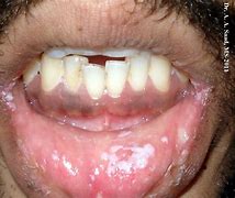 Image result for Candidiasis