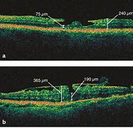 Image result for Macular Pseudohole Oct