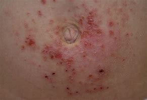 Image result for Nickel Contact Dermatitis