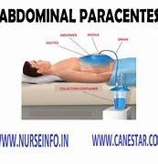 Image result for Paracentesis Infection