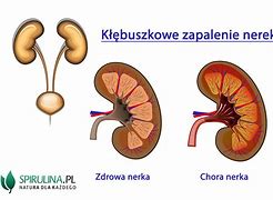 Image result for co_to_znaczy_zapalenie_nerek