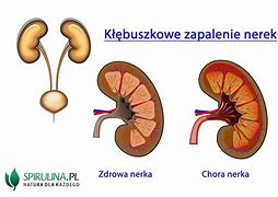 Image result for co_to_znaczy_Źródło_zakażenia