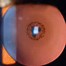 Image result for Corneal Layers Slit Lamp