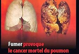Image result for Cancer Poumon