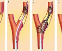 Image result for Carotid Artery Angioplasty with Stenting