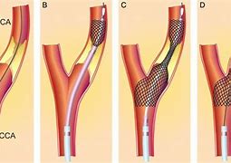 Image result for Carotid Artery Stenosis Surgery