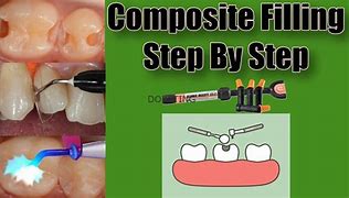 Image result for Tooth Filling Procedure