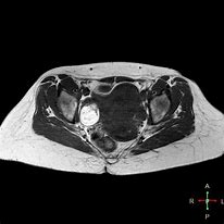 Image result for Dermoid Cyst Uterus