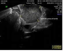 Image result for Cervical Cancer Ultrasound