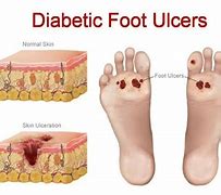 Image result for Diabetic Toe Ulcer