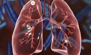 Image result for Cancerous Lung Nodules