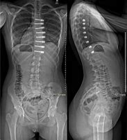 Image result for Tethering for Scoliosis