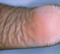 Image result for acicosis