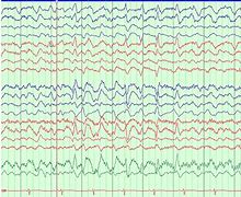 Image result for Triphasic Waves EEG