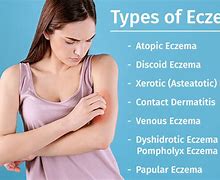 Image result for Types of Eczema