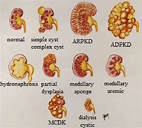 Image result for Complex Renal Cyst Size Chart