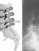 Image result for Osteophytes Lumbar Spine