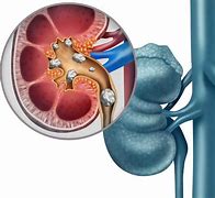 Image result for Kidney Stone Lithotripsy