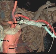 Image result for Angiogram Arm