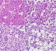 Image result for Pancreas Pathology