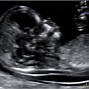 Image result for Spina Bifida Fetal Ultrasound