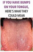 Image result for Large Bumps On Back of Tongue