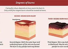 Image result for 6th Degree Burn
