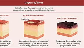 Image result for 100 Degree Burn