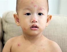 Image result for Chickenpox Kids