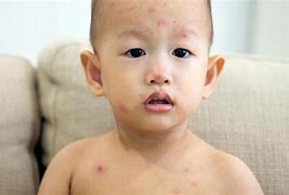 Image result for Chicken Pox On Baby