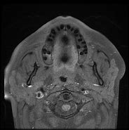 Image result for Schneiderian Papilloma