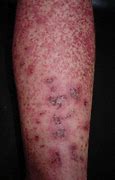 Image result for Leukocytoclastic Vasculitis Palpable Purpura