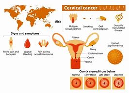 Image result for Advanced Cervical Cancer