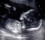 Image result for Anencephaly 10 Week Ultrasound