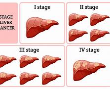 Image result for Liver Tumor