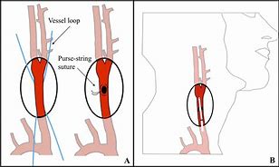 Image result for Carotid Endarterectomy Incision