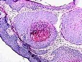 Image result for Molluscum Contagiosum Histopathology