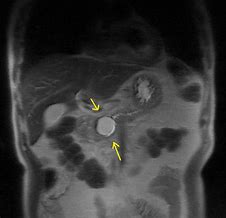 Image result for Groove Pancreatitis Radiology
