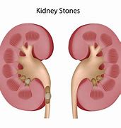 Image result for Kidney Stone Woman
