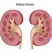 Image result for Kidney Stone with Blood