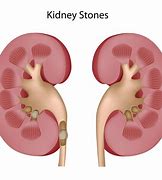 Image result for Different Types Kidney Stones