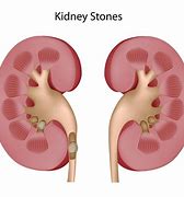 Image result for Kidney Stone in Bladder