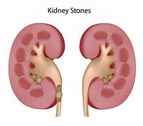 Image result for Flank Pain Kidney Stone