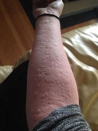 Image result for Allergic Reaction Arm