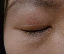 Image result for Syringoma Removal Cream