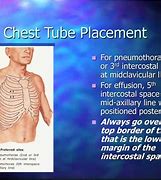 Image result for Chest Tube Positioning