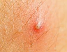 Image result for Ingrown Hair On Forearm