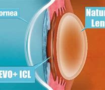 Image result for ICL Refractive Surgery