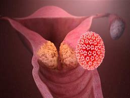 Image result for What Does Cervical Cancer Look Like
