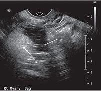 Image result for ovary dermoid cysts ultrasound